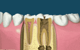 根管治疗一颗牙多少钱？